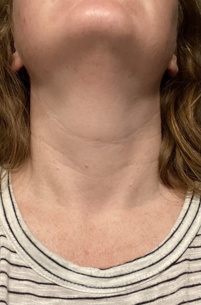 My neck, 8 weeks after the DefenAge Perfection Neck Cream with occasional use.