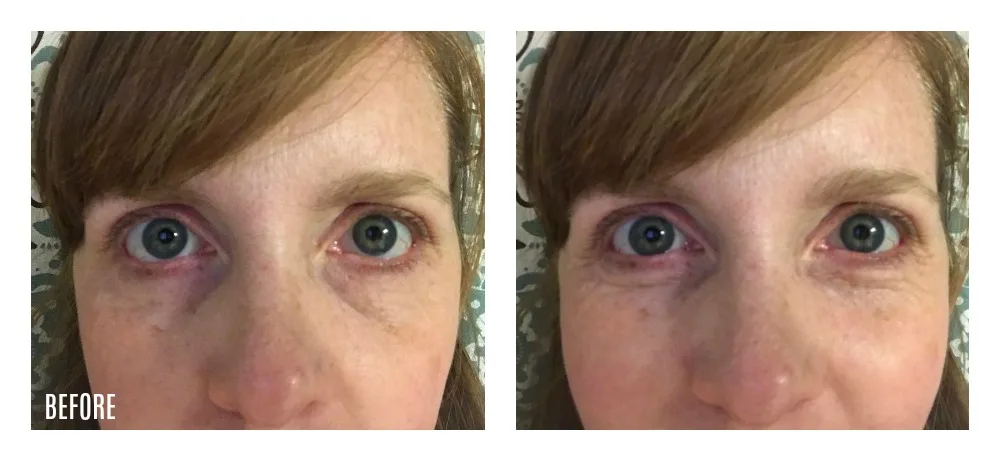 The Ordinary skin care review: Caffeine Solution 5% + EGCG after pictures